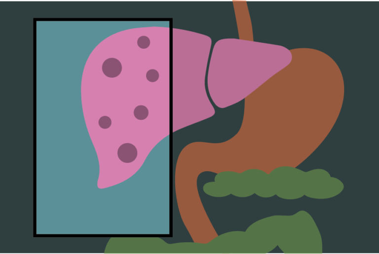 UC Davis Health developing PET imaging tool to detect liver inflammation for non-alcoholic fatty liver disease
