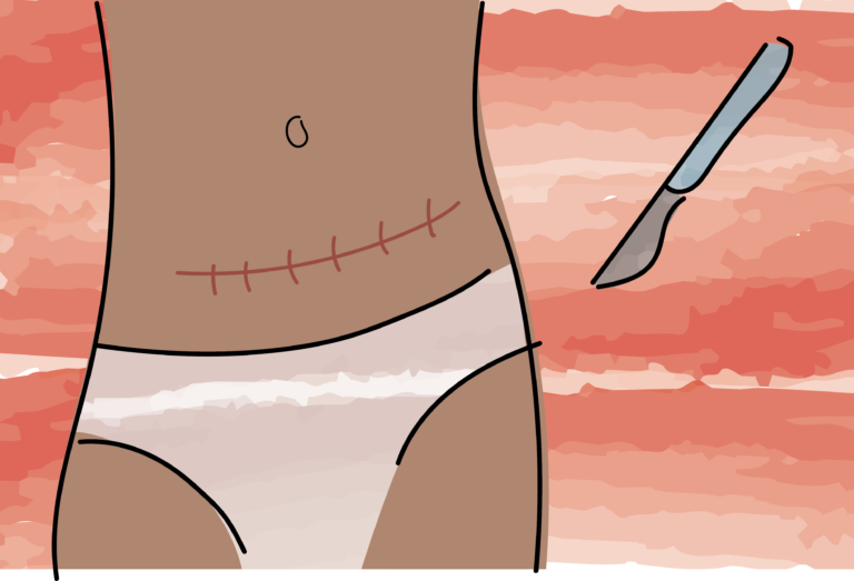 Device developed to detect hypoxia in fetuses helps prevent unnecessary cesarean sections