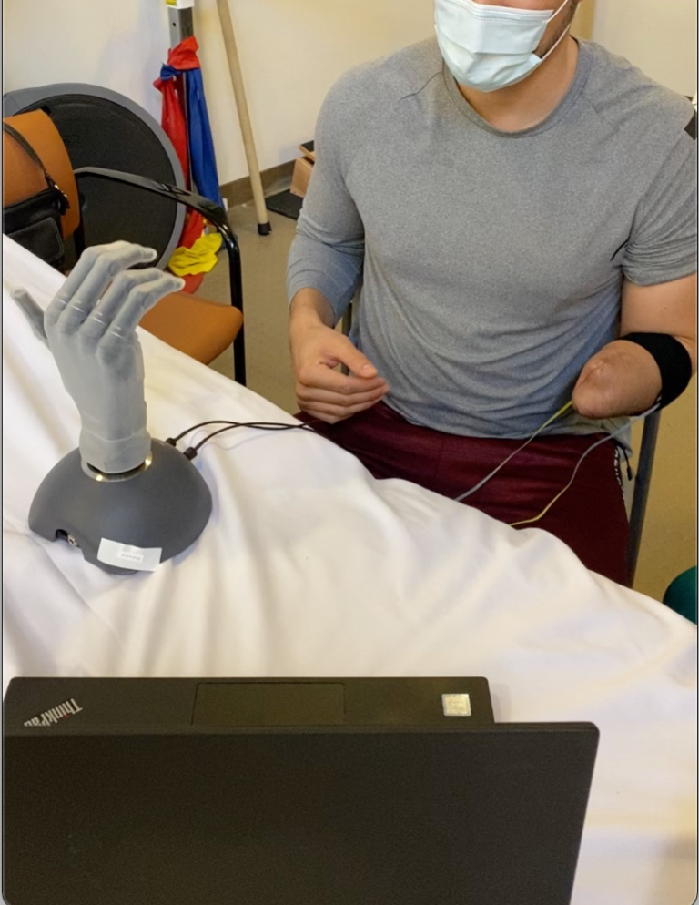 UC Davis scientists, clinicians work to optimize smart prosthetics, improve quality of life for patients with upper limb amputations