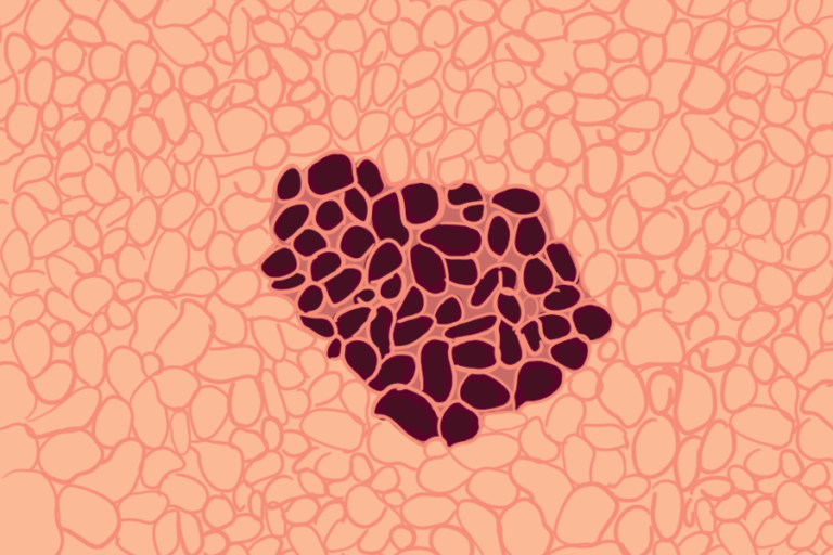 UC Davis Health finds biomarker for detecting early melanoma